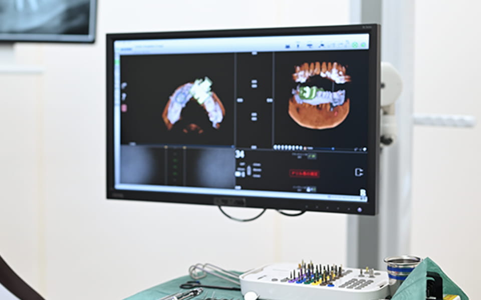 人工歯の作成と装着。長野県松本市女鳥羽の歯科・歯医者でインプラント治療なら平沼歯科医院へご相談を