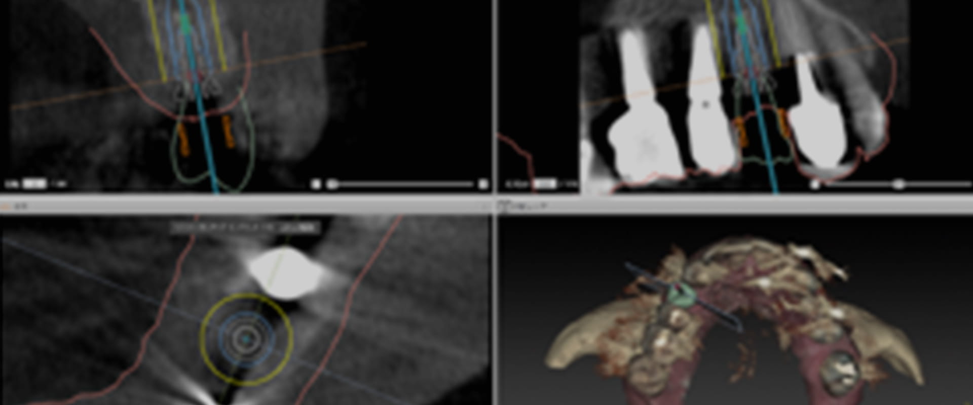 最新のインプラントナビゲーションシステム導入。長野県松本市女鳥羽の歯科・歯医者でインプラント治療なら平沼歯科医院へご相談を